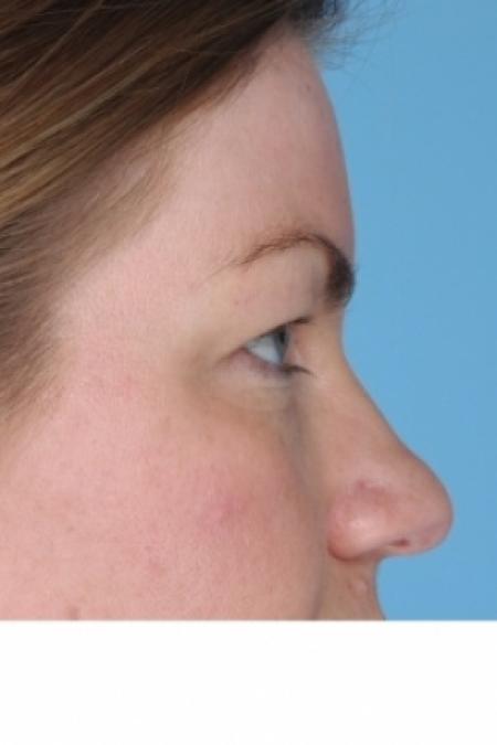 Before image 2 Case #80586 - Upper Blepharoplasty