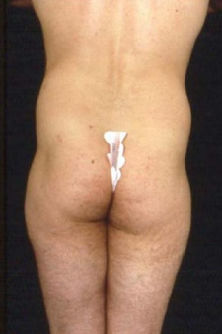 Before image 2 Case #81526 - Liposuction