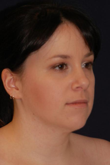 Before image 2 Case #102631 - Neck Lift