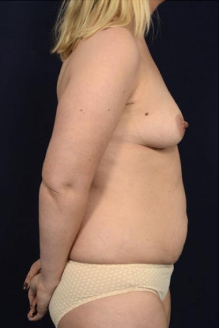 Before image 3 Case #102811 - Mommy Makeover