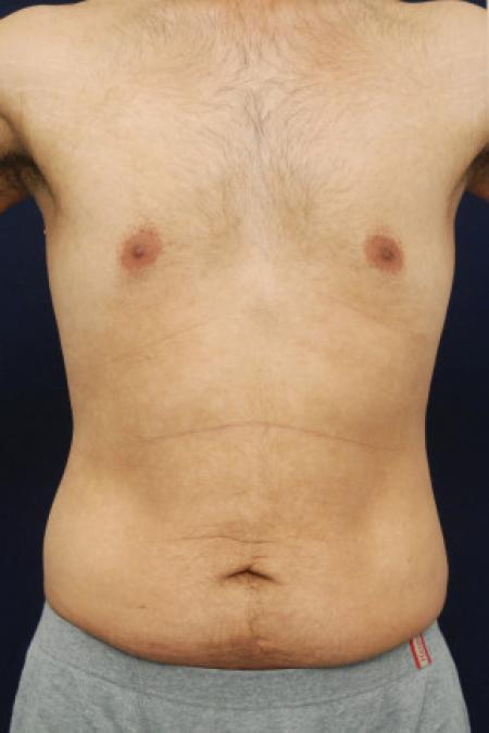 Before image 1 Case #102906 - Abdominoplasty