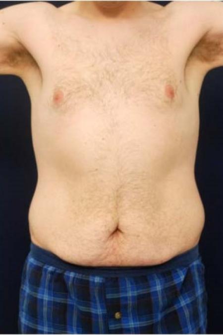 Before image 1 Case #102876 - Abdominoplasty