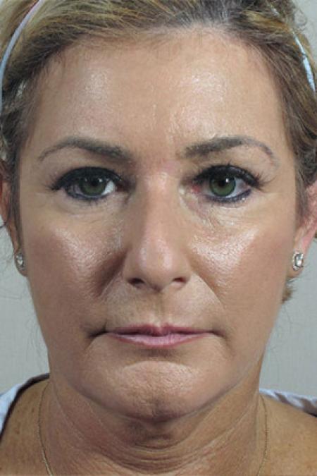 Before image 1 Case #103156 - Rhinoplasty Patient 64
