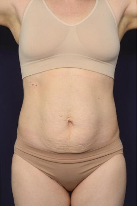 Before image 1 Case #102381 - Abdominoplasty