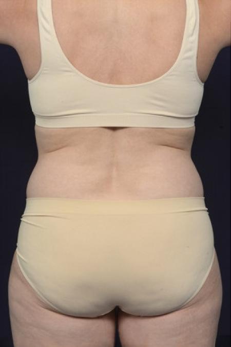 Before image 4 Case #102546 - Liposuction