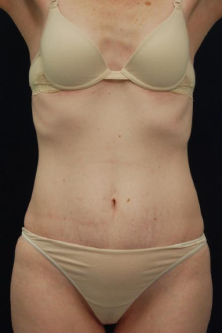 Before image 1 Case #102836 - Abdominoplasty
