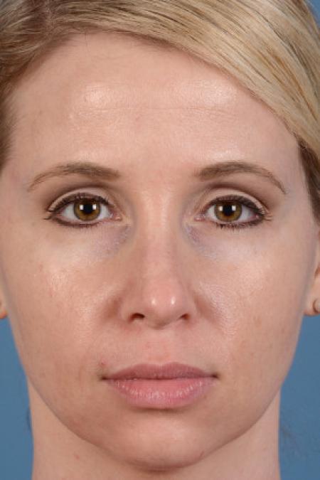 Before image 1 Case #102156 - Dermal Fillers - 33-year-old woman