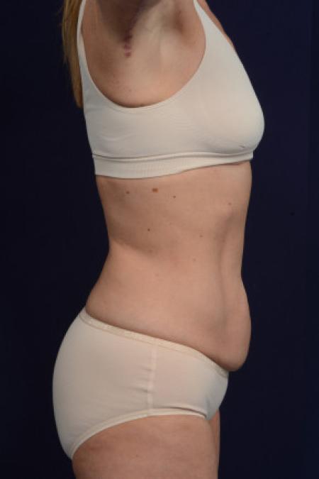 Before image 3 Case #102761 - Abdominoplasty