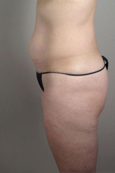 Before image 3 Case #103191 - Upper Arm and tummy Liposuction Patient 13