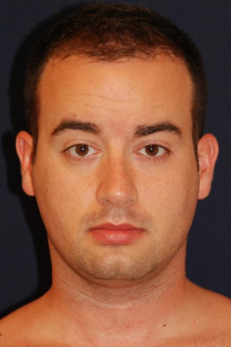 Before image 1 Case #102786 - Neck Lift