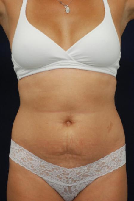 Before image 1 Case #102891 - Abdominoplasty