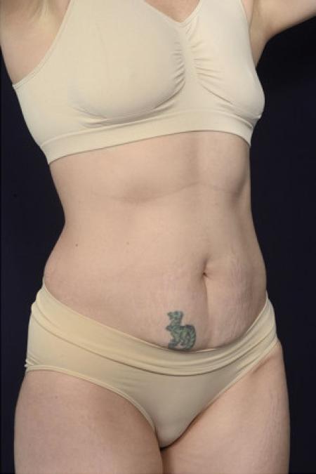 Before image 2 Case #102956 - Abdominoplasty