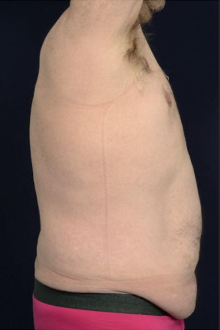 Before image 2 Case #102946 - Abdominoplasty