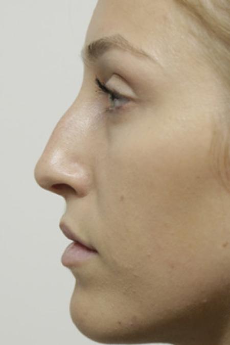 Before image 3 Case #103376 - Endonasal Closed ("Scarless") Rhinoplasty