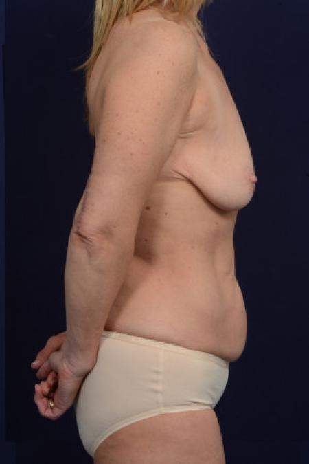 Before image 3 Case #102766 - Mommy Makeover