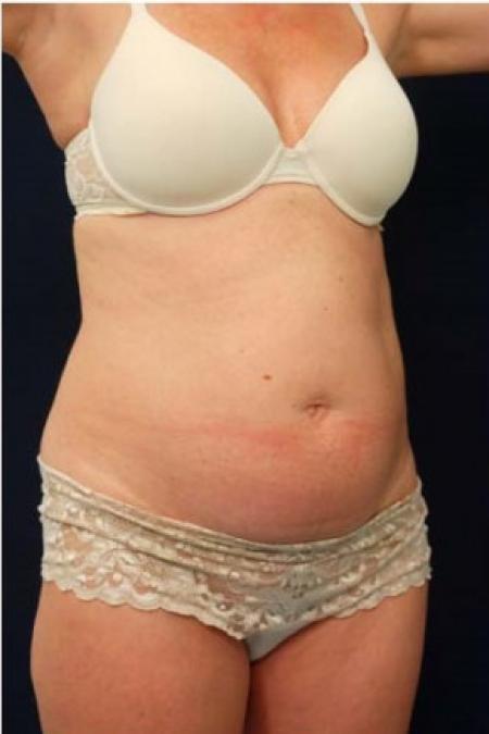 Before image 2 Case #102871 - Abdominoplasty