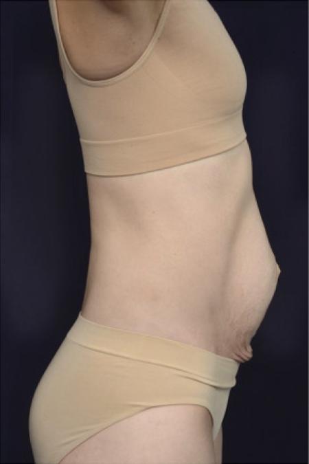 Before image 3 Case #102951 - Abdominoplasty