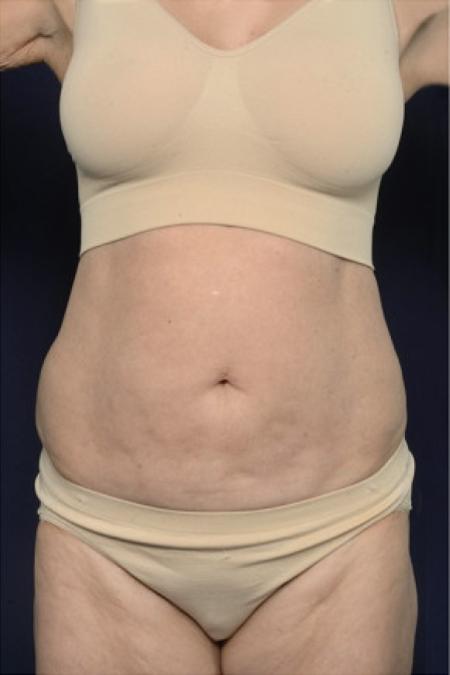 Before image 1 Case #102406 - Abdominoplasty