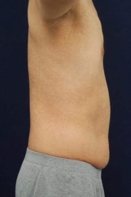 Before image 3 Case #102906 - Abdominoplasty