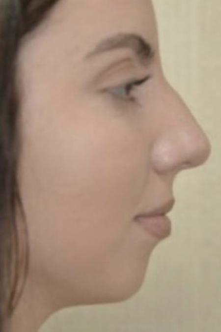 Before image 2 Case #103111 - Rhinoplasty