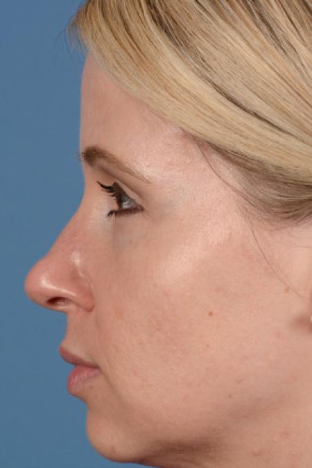 Before image 3 Case #102156 - Dermal Fillers - 33-year-old woman