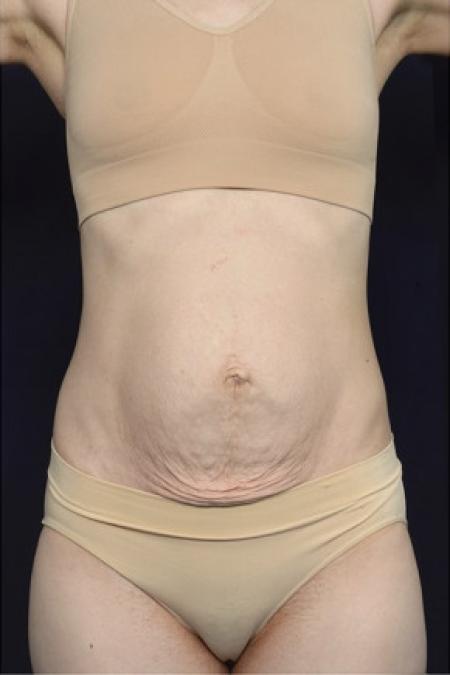 Before image 1 Case #102951 - Abdominoplasty