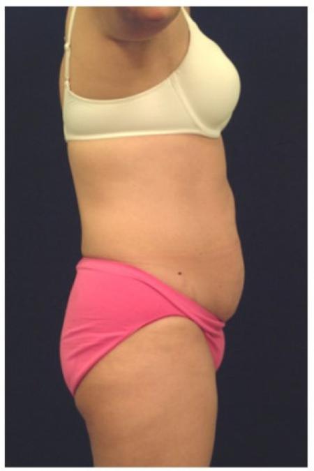 Before image 3 Case #102881 - Abdominoplasty