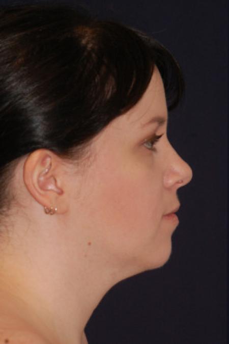 Before image 3 Case #102631 - Neck Lift