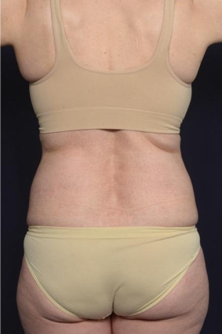 Before image 3 Case #102486 - Liposuction
