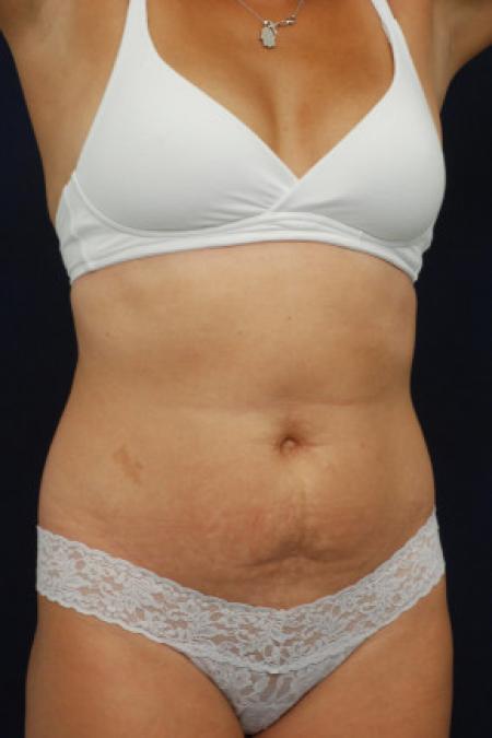Before image 2 Case #102891 - Abdominoplasty
