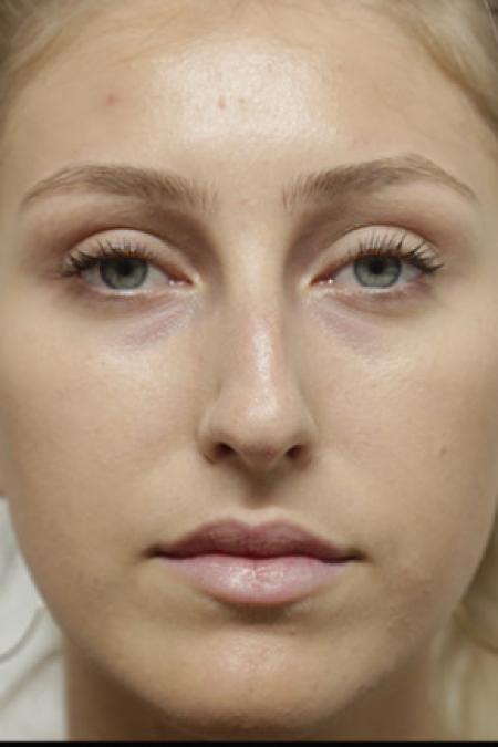 Before image 1 Case #103376 - Endonasal Closed ("Scarless") Rhinoplasty
