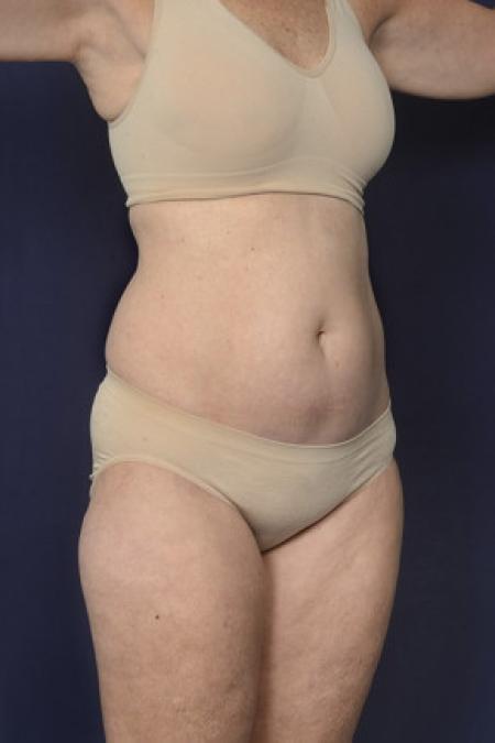 Before image 2 Case #102456 - Liposuction