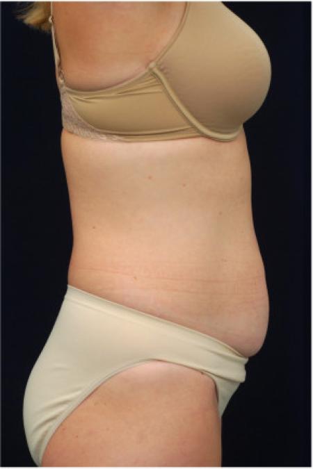 Before image 3 Case #102831 - Abdominoplasty