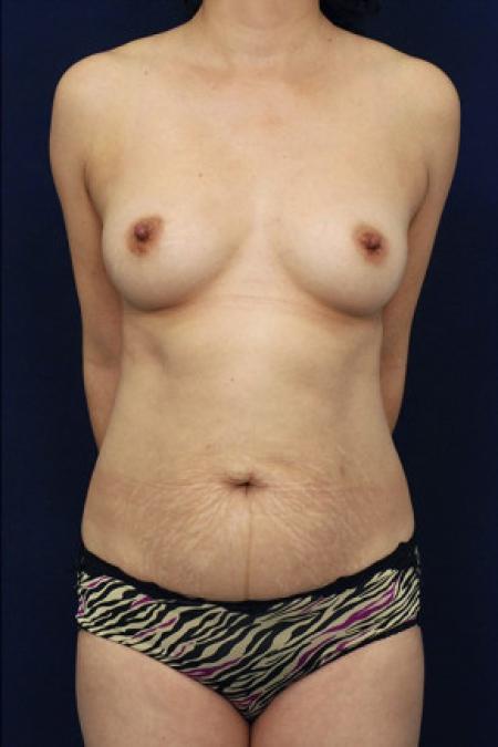 Before image 1 Case #102816 - Mommy Makeover
