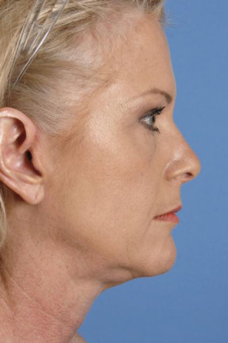 Before image 3 Case #102151 - Neck Lift - 55-year-old woman