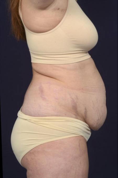 Before image 3 Case #102591 - Abdominoplasty