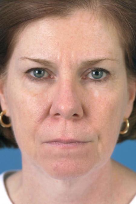Before image 1 Case #102146 - Facelift - 57-year-old woman