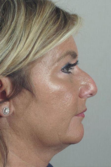 Before image 2 Case #103156 - Rhinoplasty Patient 64