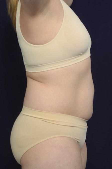 Before image 3 Case #102546 - Liposuction