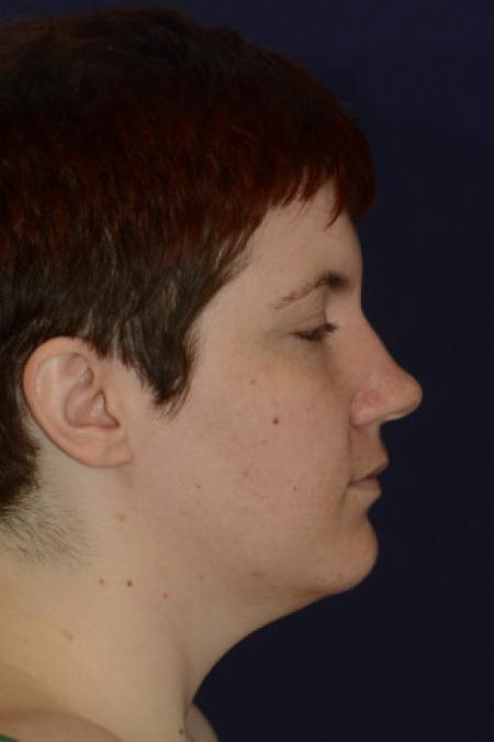 Before image 3 Case #102796 - Neck Lift