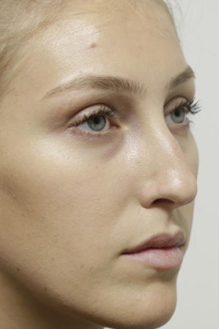Before image 2 Case #103376 - Endonasal Closed ("Scarless") Rhinoplasty