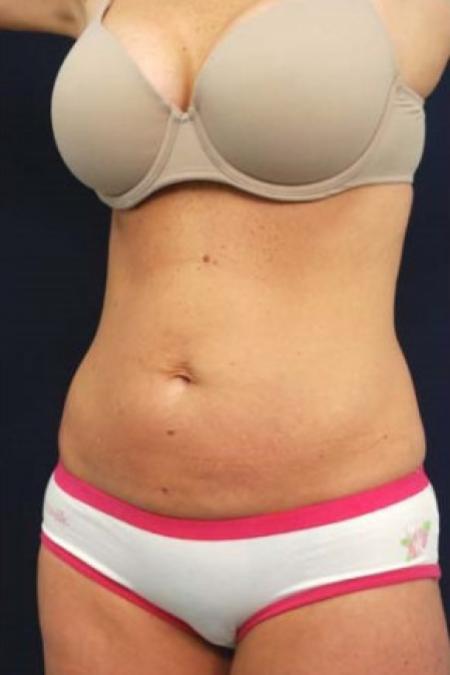 Before image 2 Case #102861 - Abdominoplasty