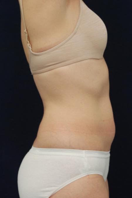 Before image 3 Case #102846 - Abdominoplasty