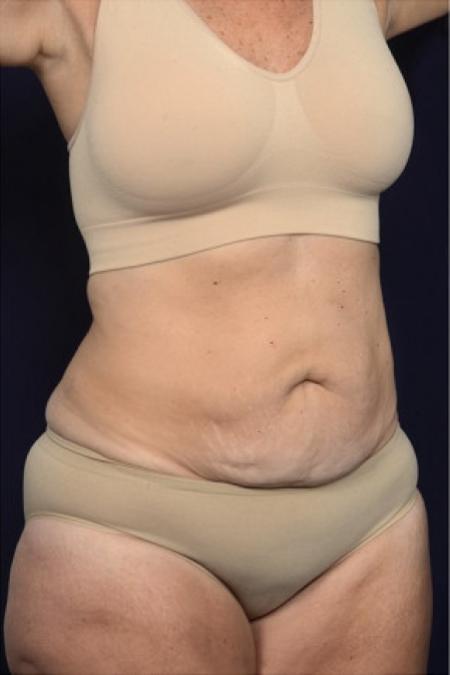 Before image 2 Case #102441 - Abdominoplasty