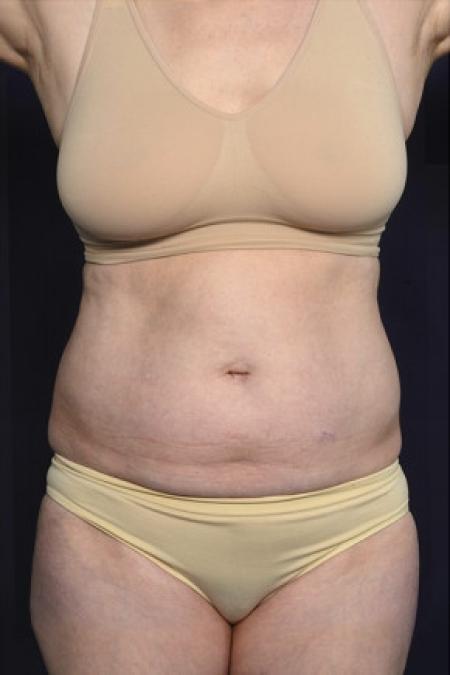 Before image 1 Case #102486 - Liposuction