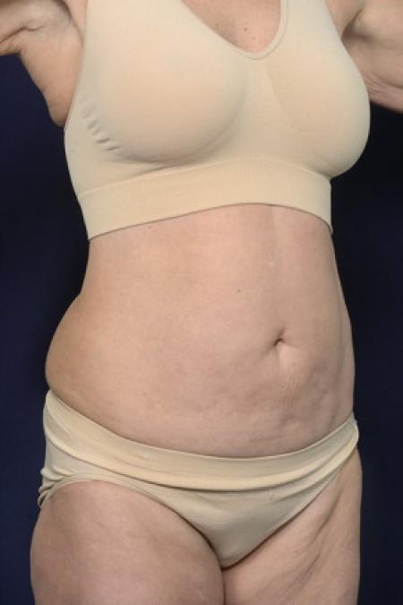 Before image 2 Case #102406 - Abdominoplasty