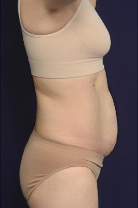 Before image 3 Case #102381 - Abdominoplasty