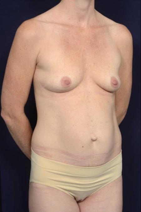 Before image 2 Case #102576 - Mommy Makeover