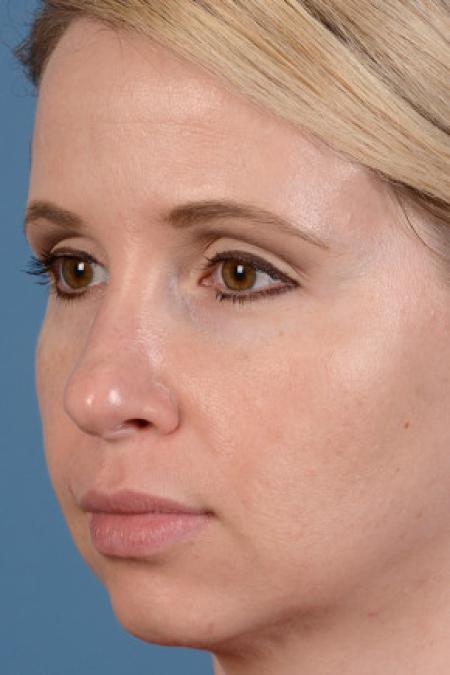 Before image 2 Case #102156 - Dermal Fillers - 33-year-old woman