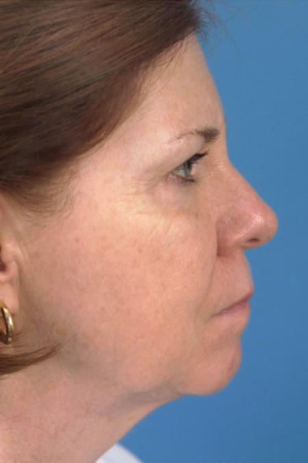 Before image 3 Case #102146 - Facelift - 57-year-old woman